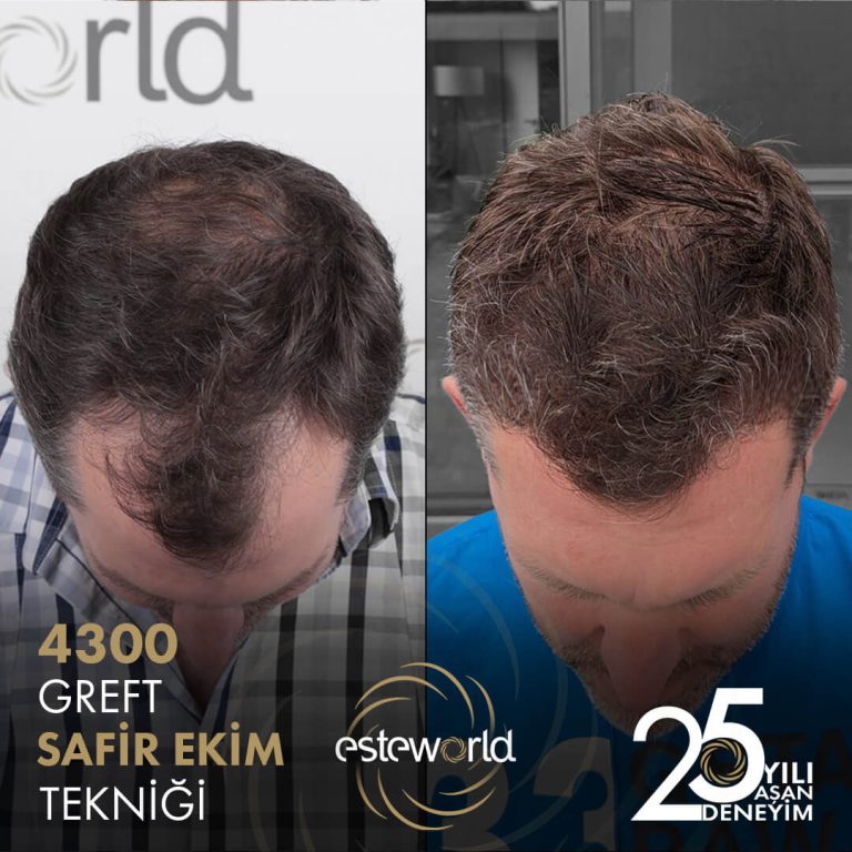 Before-After-5-Safir