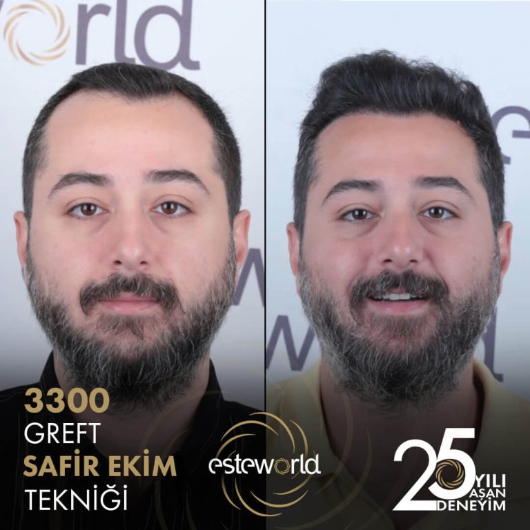 Before-After-8-Safir