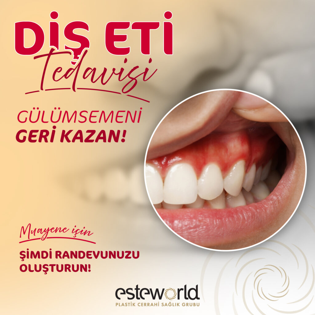 Pembe Estetik (Diş Eti Estetiği)