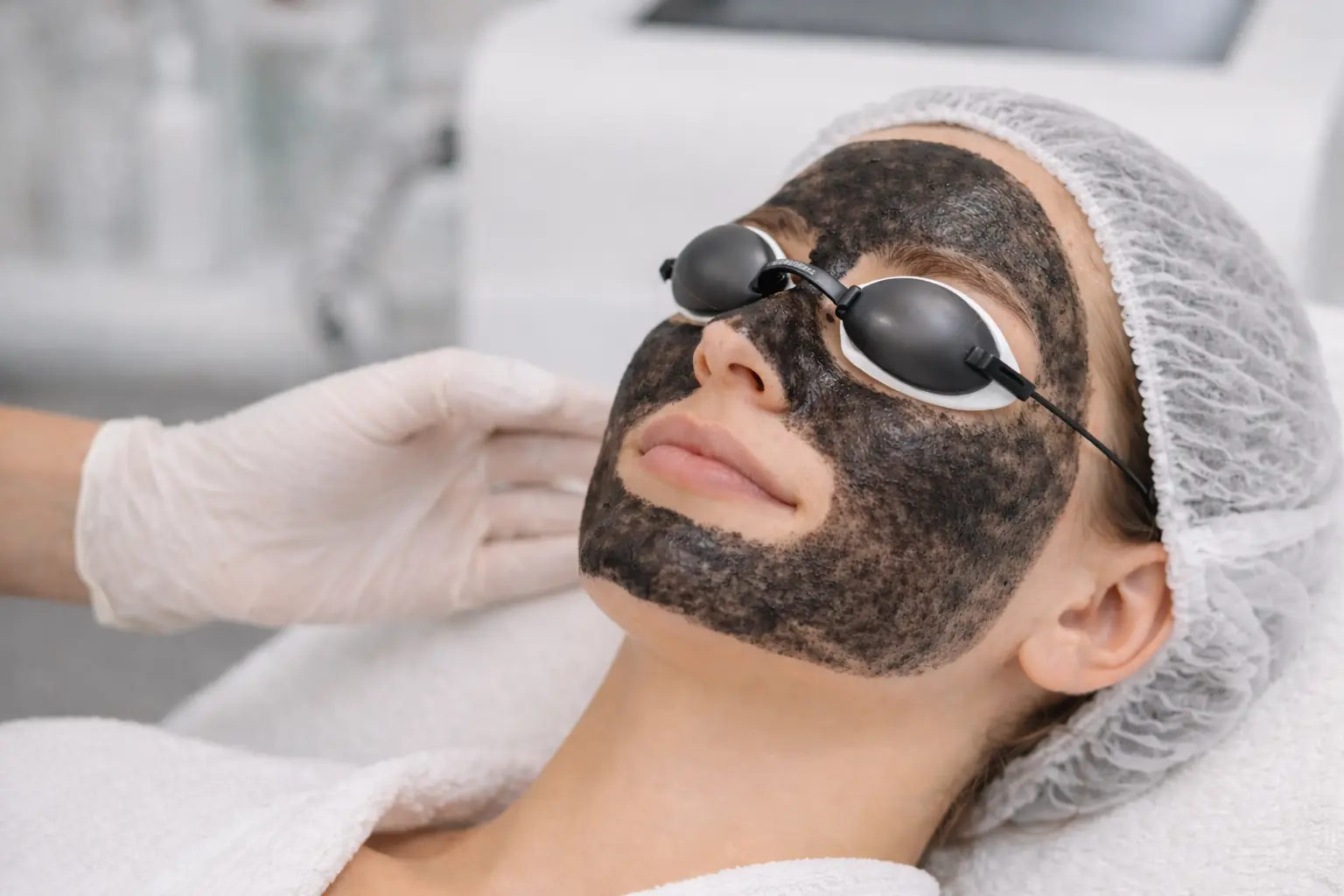 Karbon Peeling Akne Tedavisinde Ne Kadar Etkilidir?