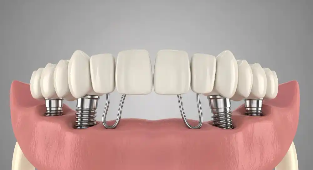 All-on-4 İmplant